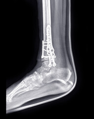Poster - x-ray image of ankle joint showing surgical treatment by internal fixation with plate and screw.