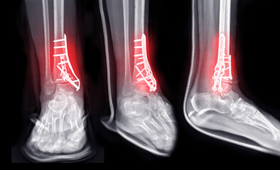 Poster - x-ray image of ankle joint showing surgical treatment by internal fixation with plate and screw.