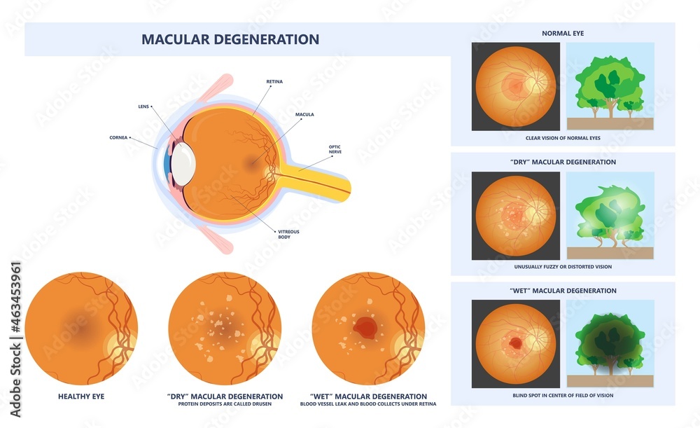 Stunning Macular Degeneration Eye Test Abstract Photography Stunning Macular Degeneration Eye Test Abstract Photography