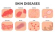 Skin disease. Different diseases, epidermis surface with eczema. Dermatology, allergy symptoms. Human body psoriasis, medical recent vector set