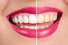 Before And After Teeth Whitening, Closeup Shot. Left Half Of Image Of Beautiful White Teeth And Right Half Of Yellow Teeth 