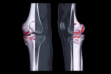 Poster - Compare of CT knee joint 3D rendering image and CT knee sagittal view and CT knee 2D Sagittal view isolated on black background showing fracture tibia bone.