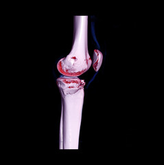 Poster - CT knee joint 3D rendering image  showing fracture tibia bone