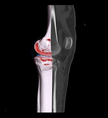 Poster - Compare of CT knee joint 3D rendering image and CT knee 2D isolated on black background showing fracture tibia bone.