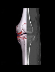 Poster - Compare of CT knee joint 3D rendering image and CT knee 2D isolated on black background showing fracture tibia bone.