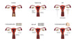 Contraception methods. IUD, contraceptive patch, pills, mini-pill, condom, vaginal ring. Vector medical illustration.