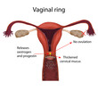 Vaginal ring. Sperm, egg, uterus. Contraception methods. Vector medical illustration.