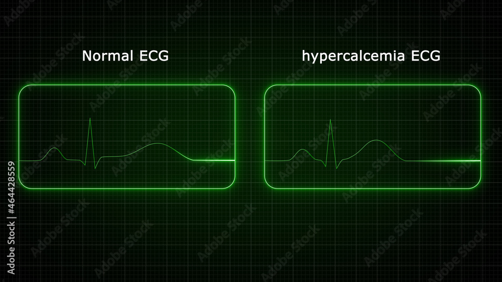 Hyperkalemia is the medical term that describes a potassium level in ...