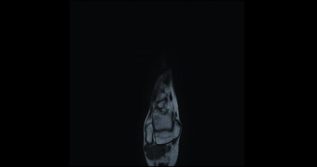 Poster - MRI FOOT Coronal PDW  for diagnostic tendon of foot injury.