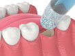 © Aleksandra Gigowska - 3D render of dental bone grafting with dental bone biomaterial application
