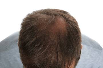 Man with hair loss problem isolated on white, above view