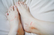 A bloody wound from a cat bite on a woman's foot can cause rabies and tetanus. Healthcare concept.