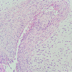 Poster - Camera photo of umbilical cord vasculitis, showing neutrophils in vascular wall, magnification 200x, photograph through a microscope