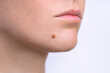 Mole on face. Young woman face with birthmark or nevus. Copy space