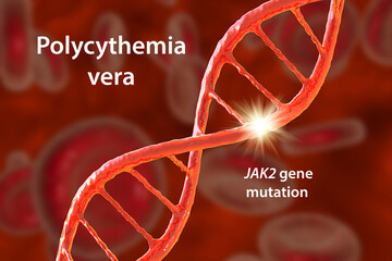 Wall Mural - Polycythemia vera, a rare slow-growing blood cancer with an increase in the number of red blood cells