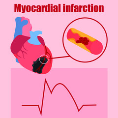 Heart attack illustration. The illustration depicts ECGs for myocardial infarction, coronary artery thrombosis and myocardial necrosis.