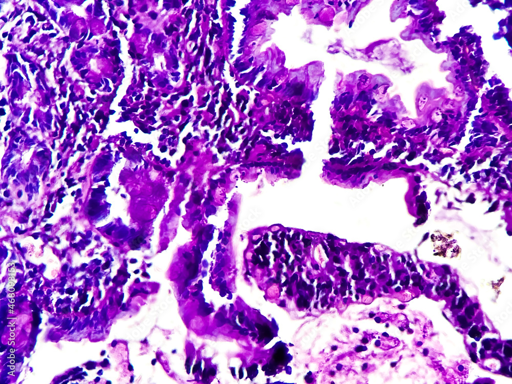 Squamous Cell Microscope Squamous cell carcinoma of a human, photomicrograph panorama as seen ...