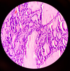 Canvas Print - Microphotograph(microscopic image) of Nodular goitre with adenomatous change in thyroid tissue, 40x view