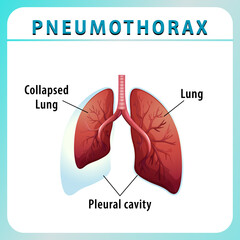 Poster - Pneumothorax diagram with collapsed lung and healthy lung