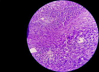 Sticker - Pancreas Cancer Awareness: Photomicrograph of CT scan-guided fine needle aspirate (FNA) cytology of a pancreatic mass showing malignant cells indicating adenocarcinoma.