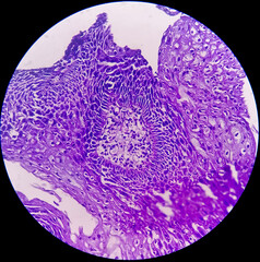 Canvas Print - Colon Cancer: Photomicrograph (microscopic image) of an invasive colonic adenocarcinoma. colorectal cancer.