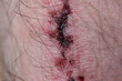 © Octavian - Bruised skin macro close up shot of hairy Caucasian male leg.