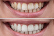© Михаил Решетников - Close-up of a woman's smile before and after teeth whitening.