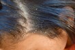 Woman's hair close-up with Dandruff, hair problem concept