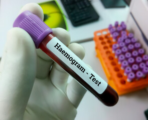 Canvas Print - Technician hold blood sample for Haemogram or CBC with lab background. complete Blood Count (CBC)