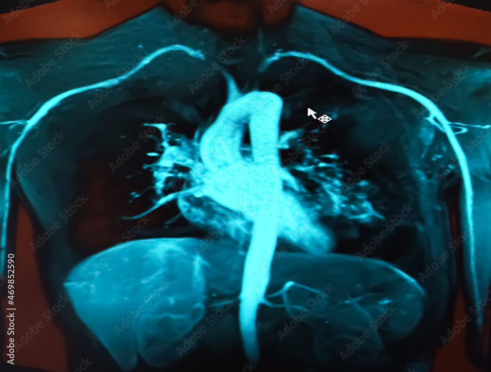 CT scan of heart and chest wall showing normal heart, lungs, artery and ...
