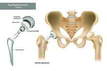 Total Hip Replacement Components And Hemiarthroplasty. Hip Implant