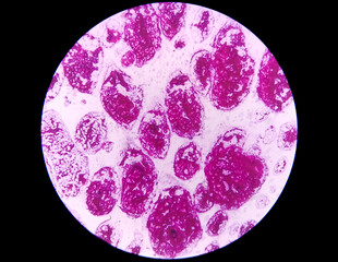 Sticker - Gram staining, also known as Gram's method, is a method of differentiating bacterial species into two large groups (Gram-positive and Gram-negative). Here, Occasinal gram positive cocci are seen. 40X