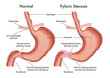 Medical illustration of symptoms of pyloric stenosis