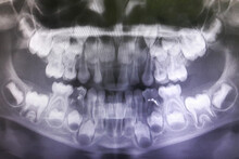 X-ray Of The Child's Upper And Lower Jaw With Clearly Visible Growing Teeth
