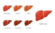Liver diseases concept in flat style, vector