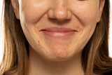 Fototapeta Miasto - Young smiling woman with the pimples on her face