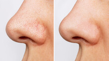 Close-up Of Woman's Nose With Blackheads Or Black Dots Before And After Peeling And Cleansing The Face Isolated On A White Background. Acne Problem, Comedones. Profile. Cosmetology Dermatology Concept