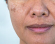 © Praewphan - Problem skincare and health concept. Closeup Asian woman face skin with melasma, Dark spots, pigment and large pores problem.