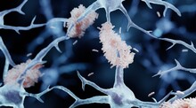 Amyloid Plaque Forming Between Neurons In Alzheimer Disease