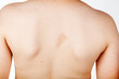 A large light brown cafe au lait spot known as birth mark on the inter scapular region of a caucasian male. This benign skin discoloration may be related to a genetical disorder neurofibromatosis.