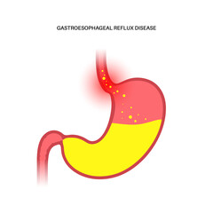 Sticker - Gastroesophageal reflux disease