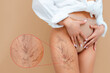 © _KUBE_ - Close up of legs of woman in panties and a white shirt poses on a beige background, showing a vascular mesh on her thigh. Zoomed area of varicose lesion. The concept of varicose veins