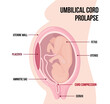Prolapsed umbilical cord, Medical vector diagram with terms