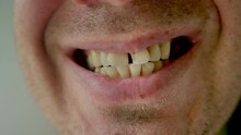 An Unshaven European Man Opens His Mouth And Shows Sick Cracked Chipped Yellow Teeth In Close-up