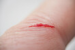 © H_Ko - Injured persons finger with bleeding open cut wound
