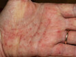 hand of a person with scarlet fever infection 