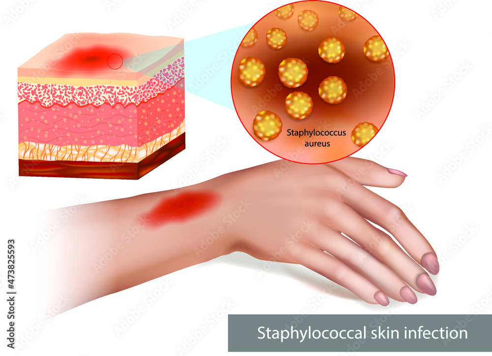 Staphylococcal skin infection or Staph infection. Infestation with ...
