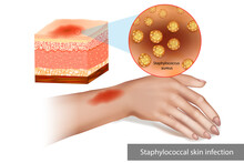 Staphylococcal Skin Infection Or Staph Infection. Superimposed Bacterial Infection Skin Cellulitis.