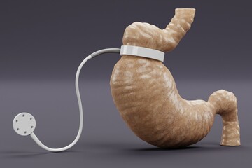 Wall Mural - Realistic 3D Render of Stomach with Gastric Band