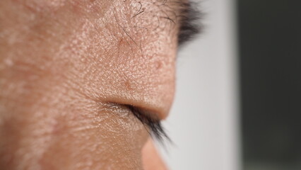 Wart on face. Macro shot of wart near eye. Papilloma on skin around eye nose and neck. Close up of birthmark Papilla or mole on skin. small hard. benign growth on the skin. caused by virus. skincare.